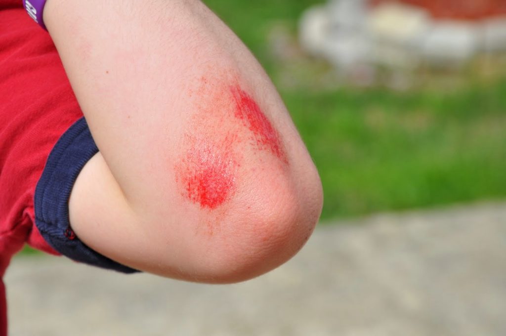 How to treat different types of cuts, grazes, and gashes - We Can