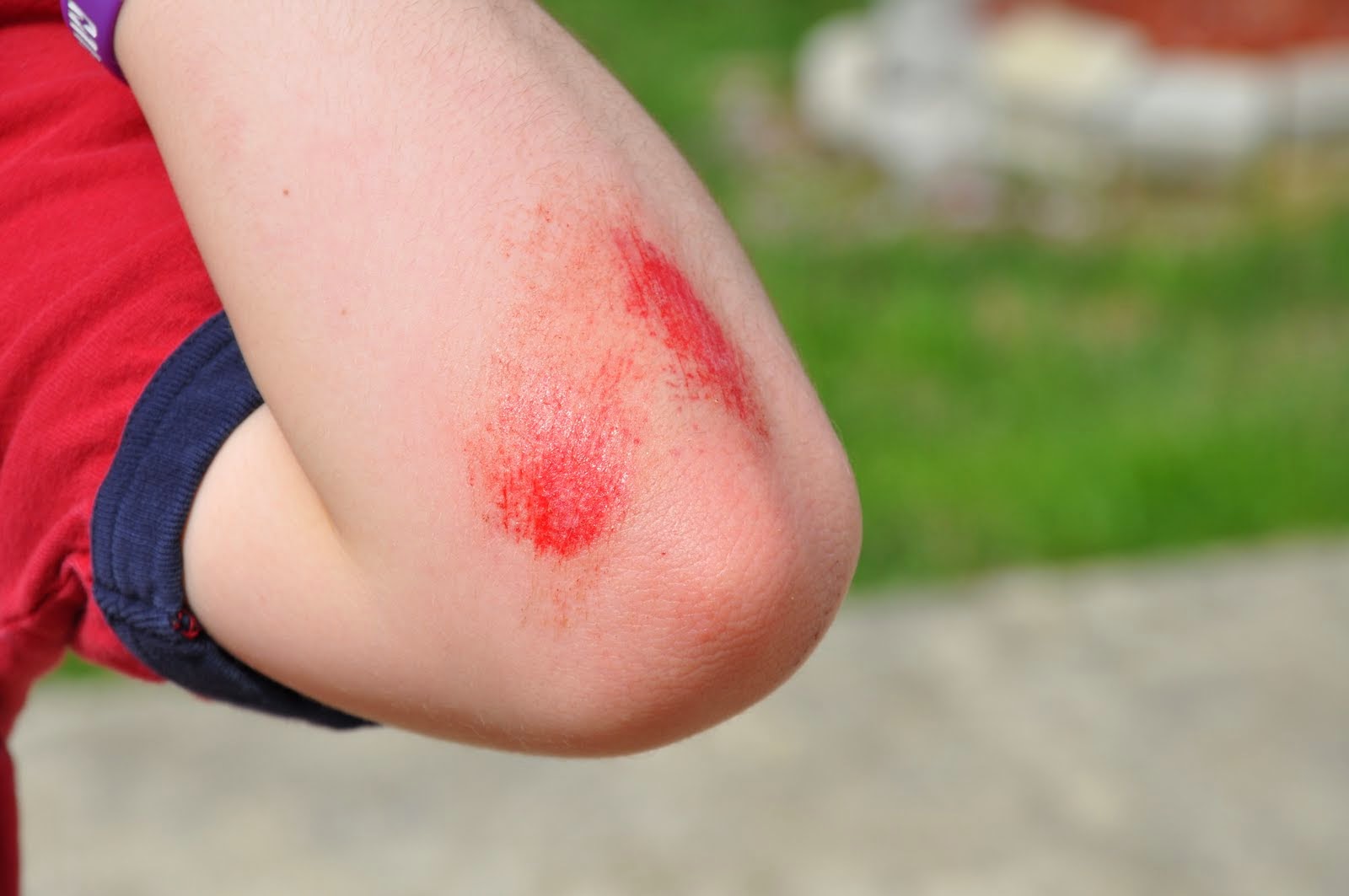 child with scrape on elbow