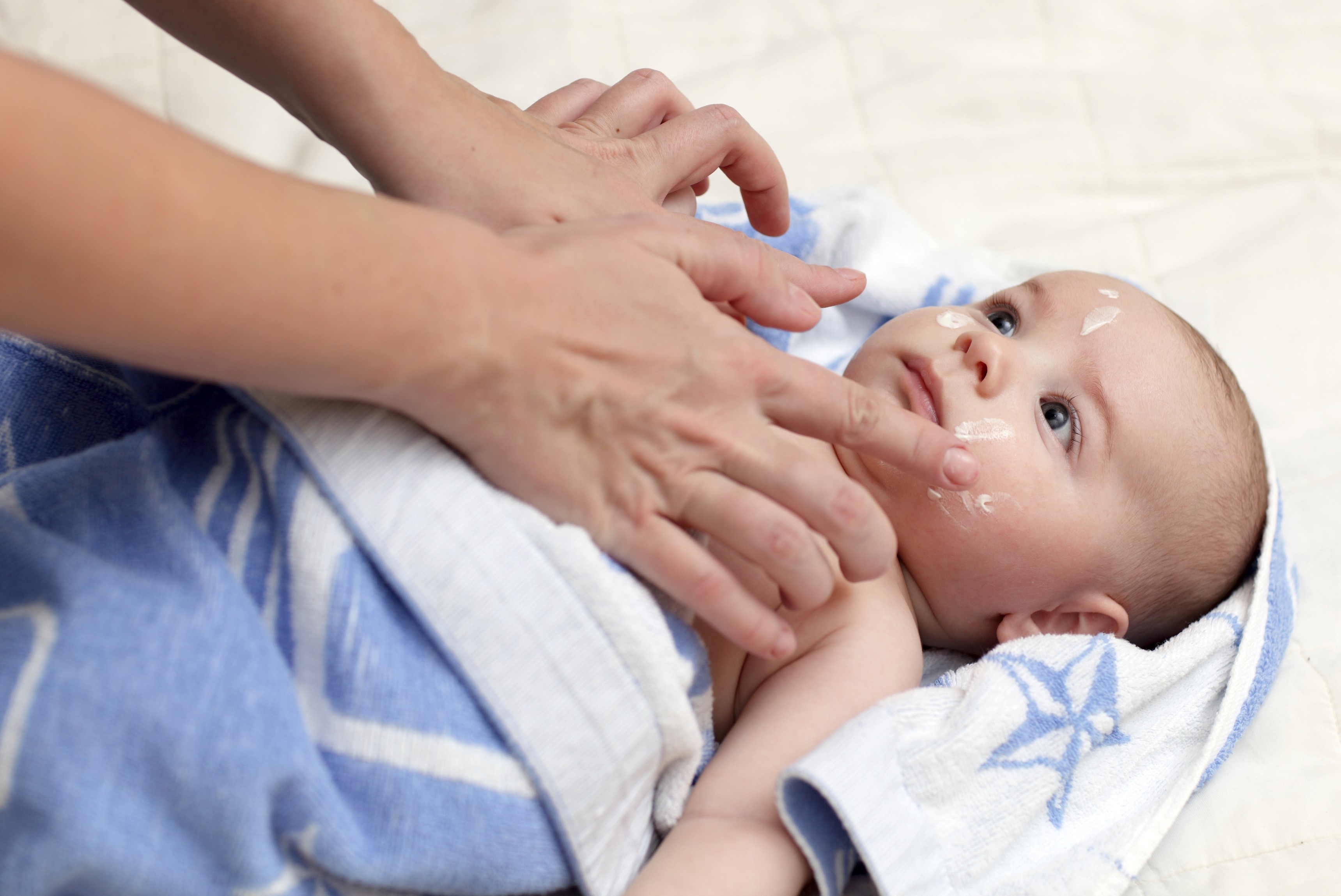 baby with eczema