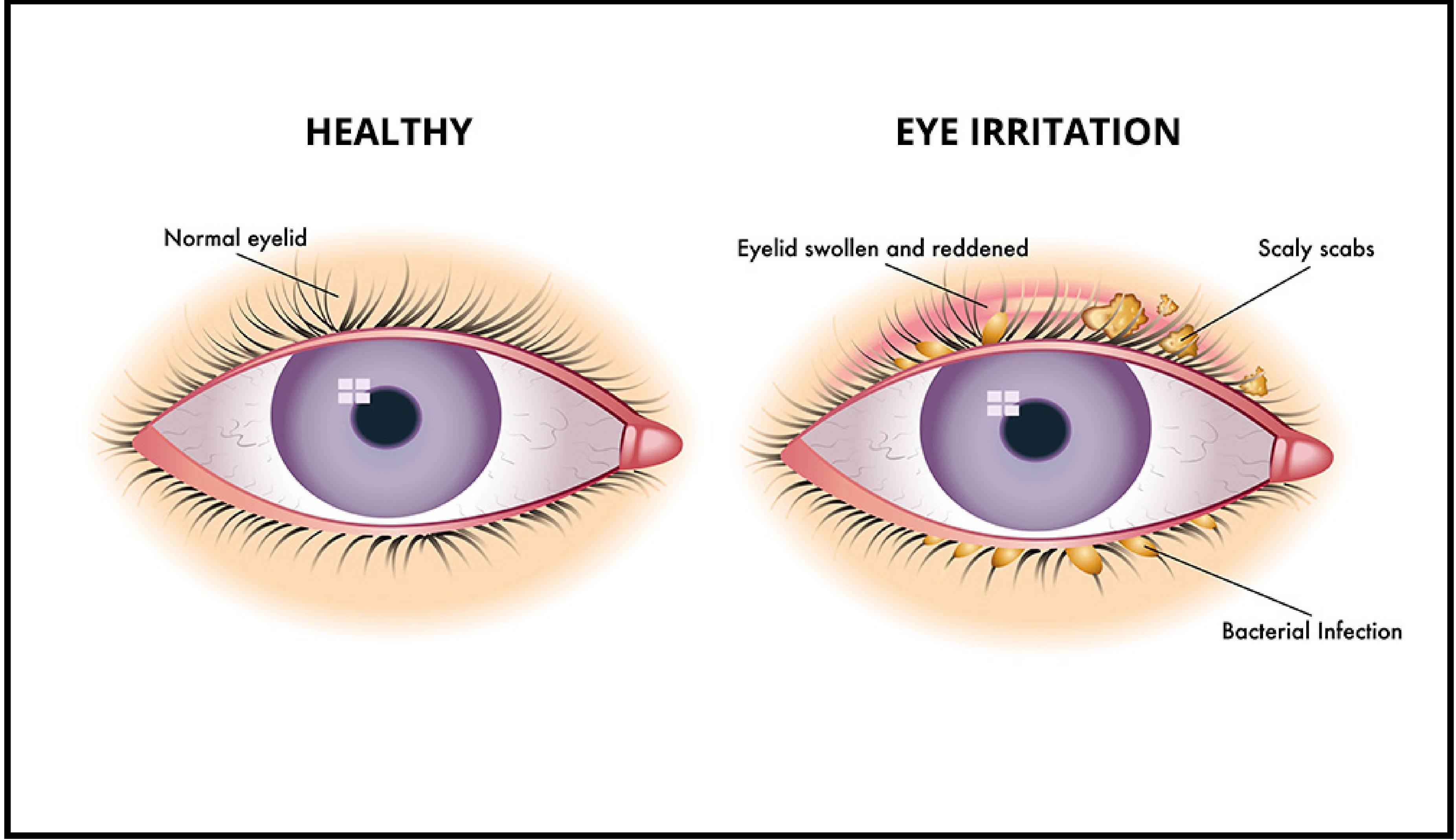 eyes with blepharitis